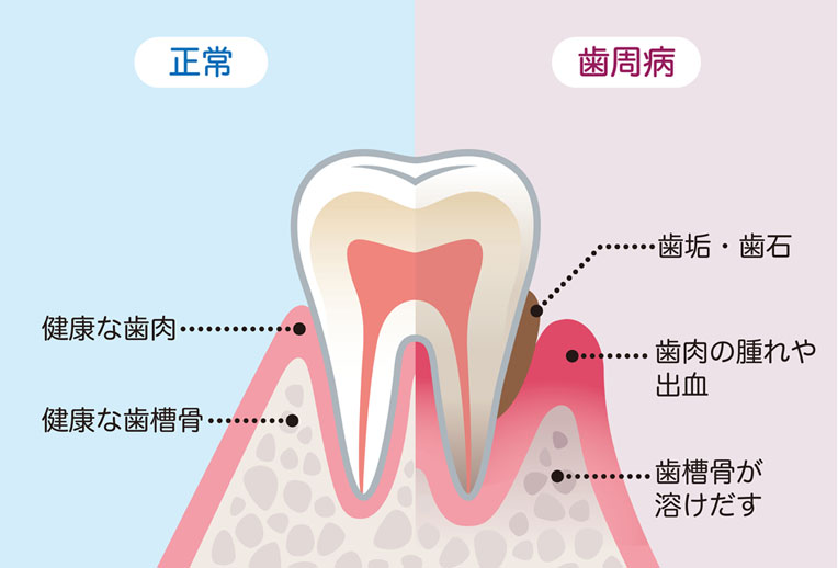 歯周病の分かりやすい図