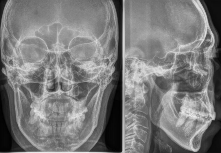 頭部X線規格写真セファロでの撮影例